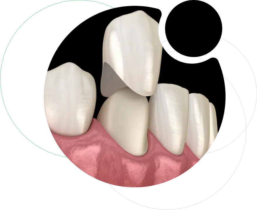 Zirconia Crowns and Bridges