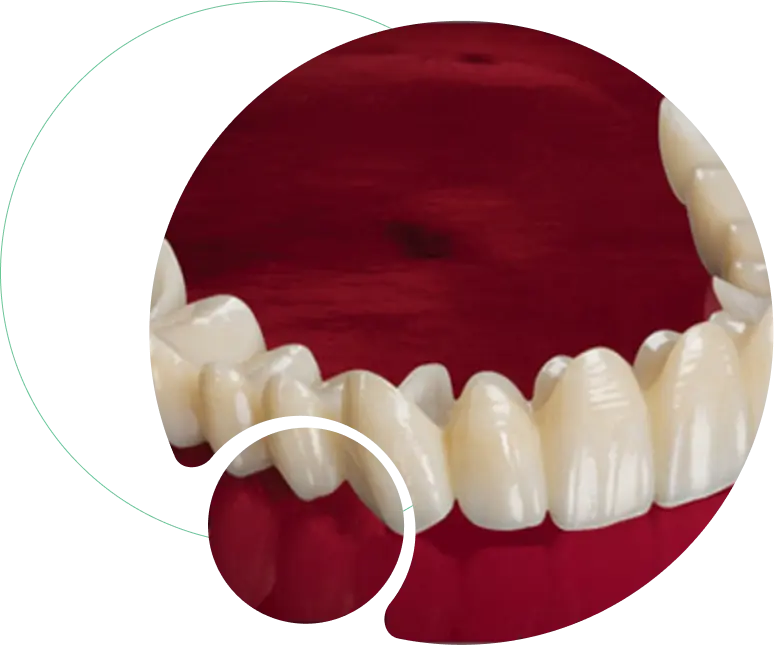 Zirconia Crowns and Bridges