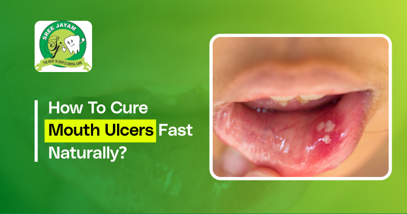 How to Cure Mouth Ulcers Fast Naturally
