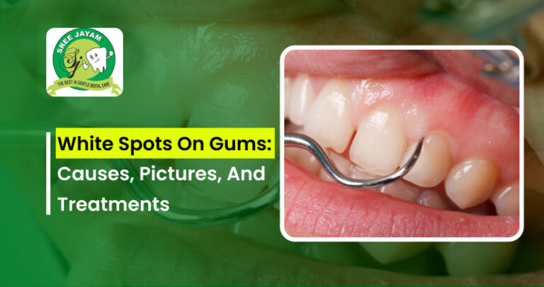 White Spots on Gums